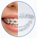 Braces and Aligners