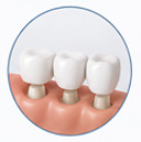 Fixed Prosthesis