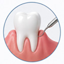 Gums Treatment